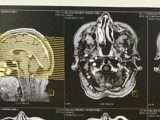 Neuralgia del trigémino: síntomas, causas y tratamiento