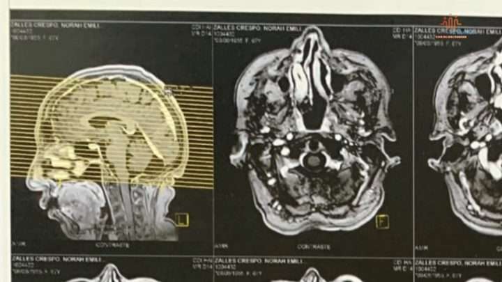 Neuralgia del trigémino: síntomas, causas y tratamiento